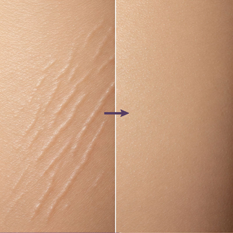 Zin Stretch Marks Removal Cream