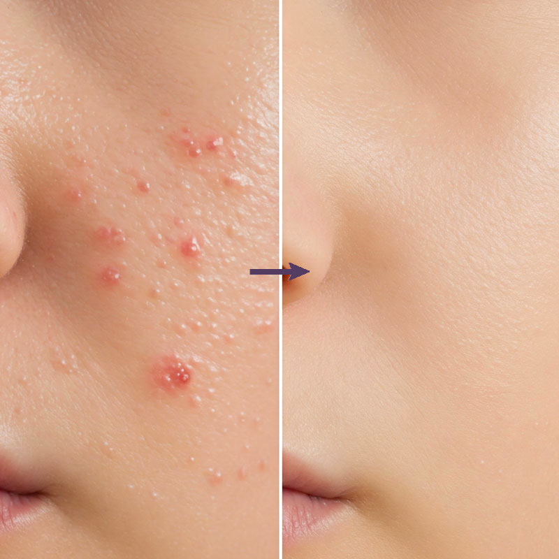 Zin Acne Cure Cream