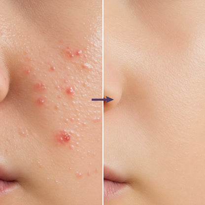 Zin Acne Cure Cream